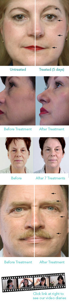 Ezzi-Lift Before and After Ezz-Lift Before and After